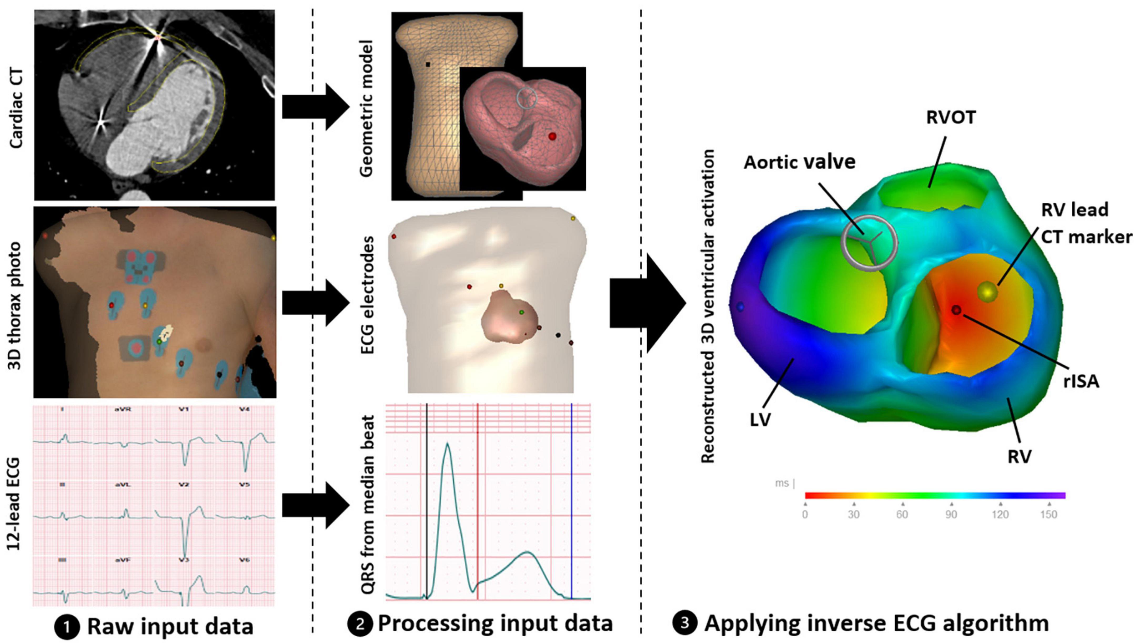 Novel non-invasive ECG imaging method based on the 12-lead ECG for reconstruction of ventricular activation: A proof-of-concept study